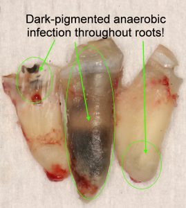 Sinus pain caused by root canal: Anaerobic infection throughout the root.