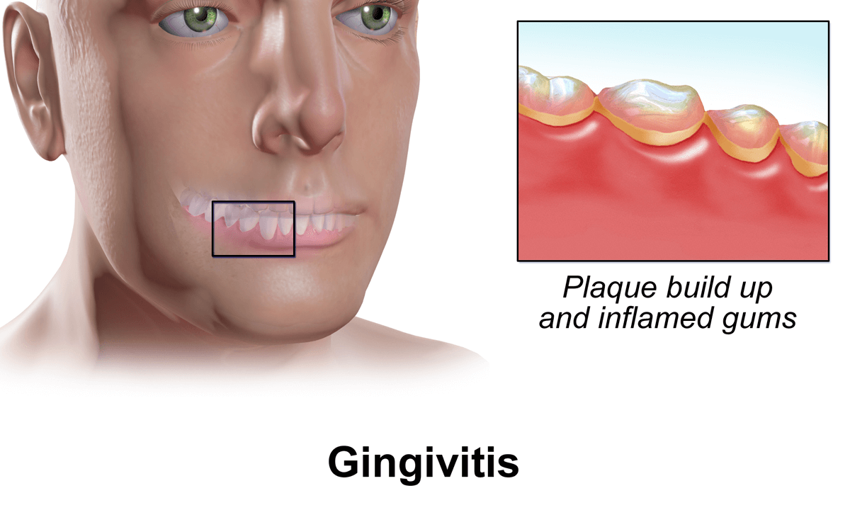 gingivitis gum disease 