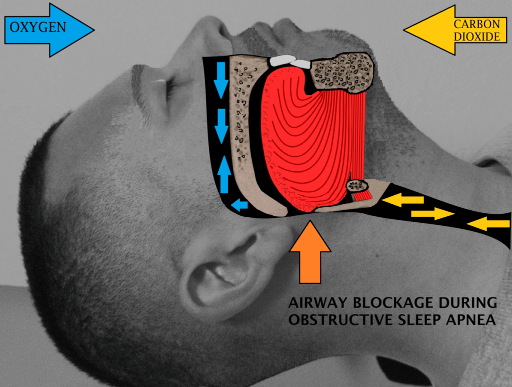 sleep apnea an airway obstruction