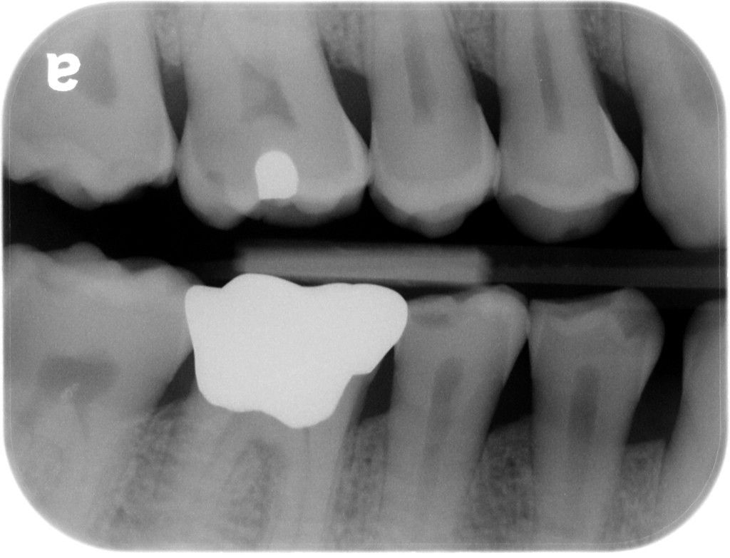 radiation dental x-ray