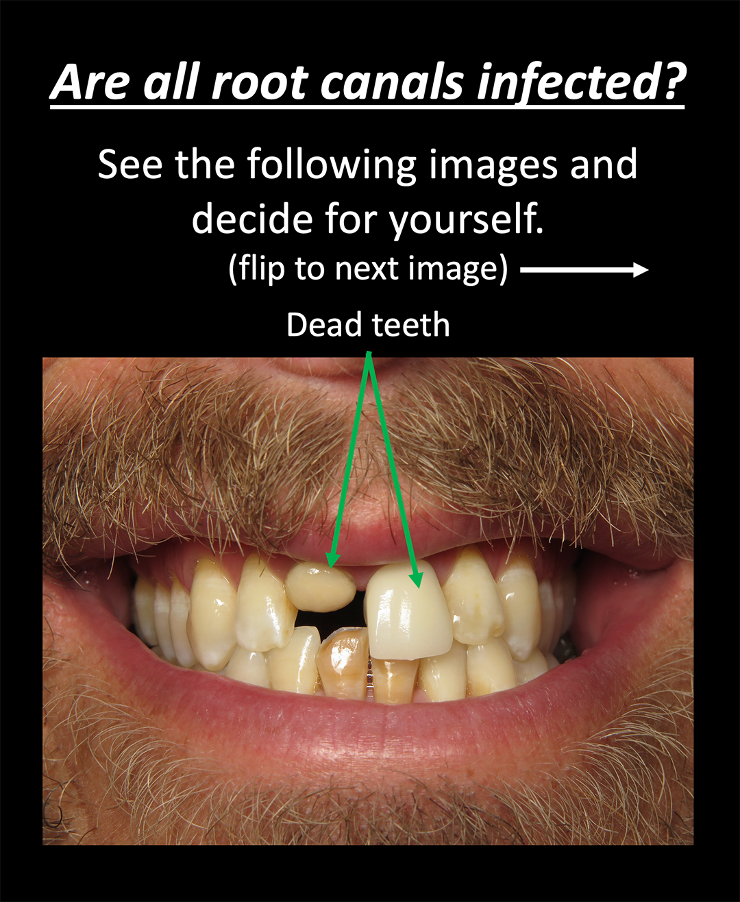 Root Canals Boise ID - Save Your Badly Infected Tooth