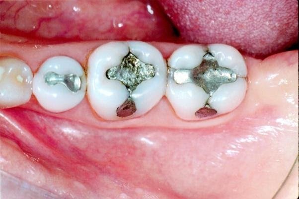 Biological Tooth Restoration