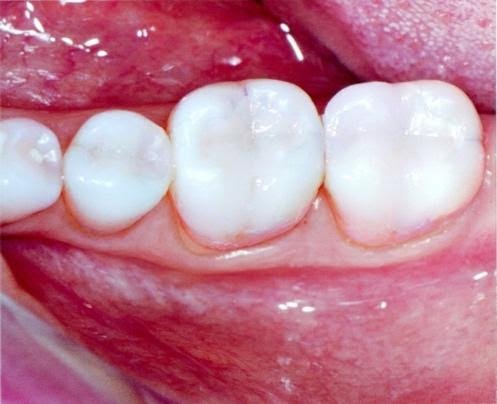 Biological Tooth Restoration Procedure