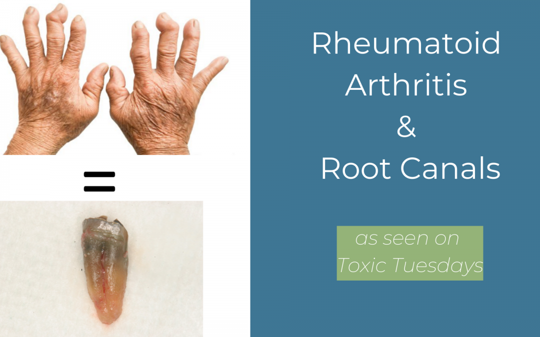 Toxic Tuesdays – Rheumatoid Arthritis and Root Canals