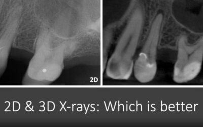 Toxic Tuesday – 2D and 3D X-rays: Which is Better?