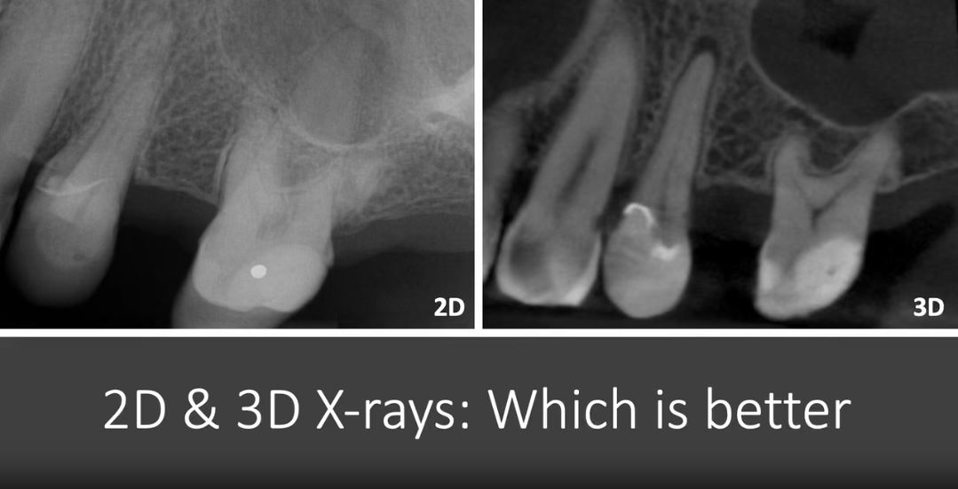Toxic Tuesday – 2D and 3D X-rays: Which is Better?