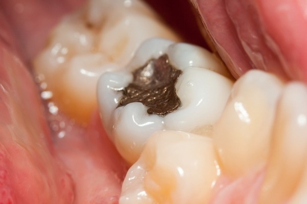 Toxic Tuesday:  The risks of putting mercury in your mouth