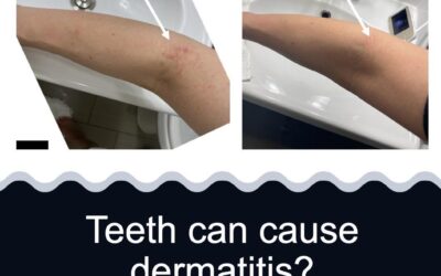 Toxic Tuesday: Dermatitis CAN Be Caused By Issues In Your Mouth