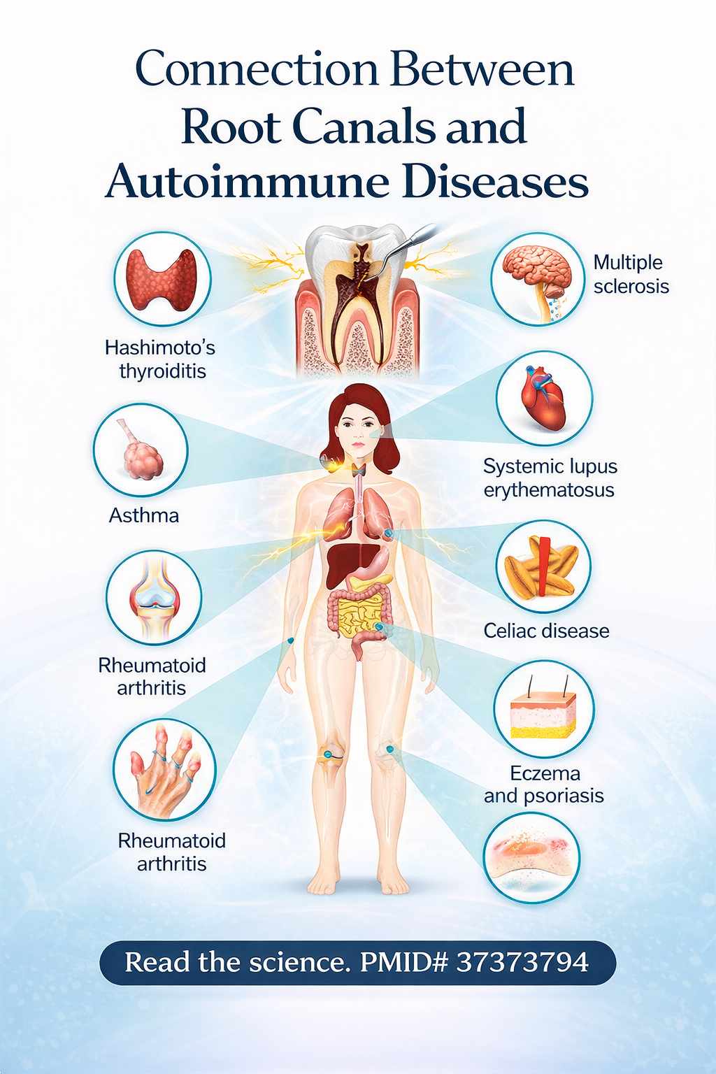 Autoimmune disease and root canal infographic illustrating the possible connection between root canal infection, chronic oral inflammation, and systemic conditions including Hashimoto’s thyroiditis, multiple sclerosis, lupus, celiac disease, rheumatoid arthritis, eczema, psoriasis, and asthma | Blodgett Dental Care